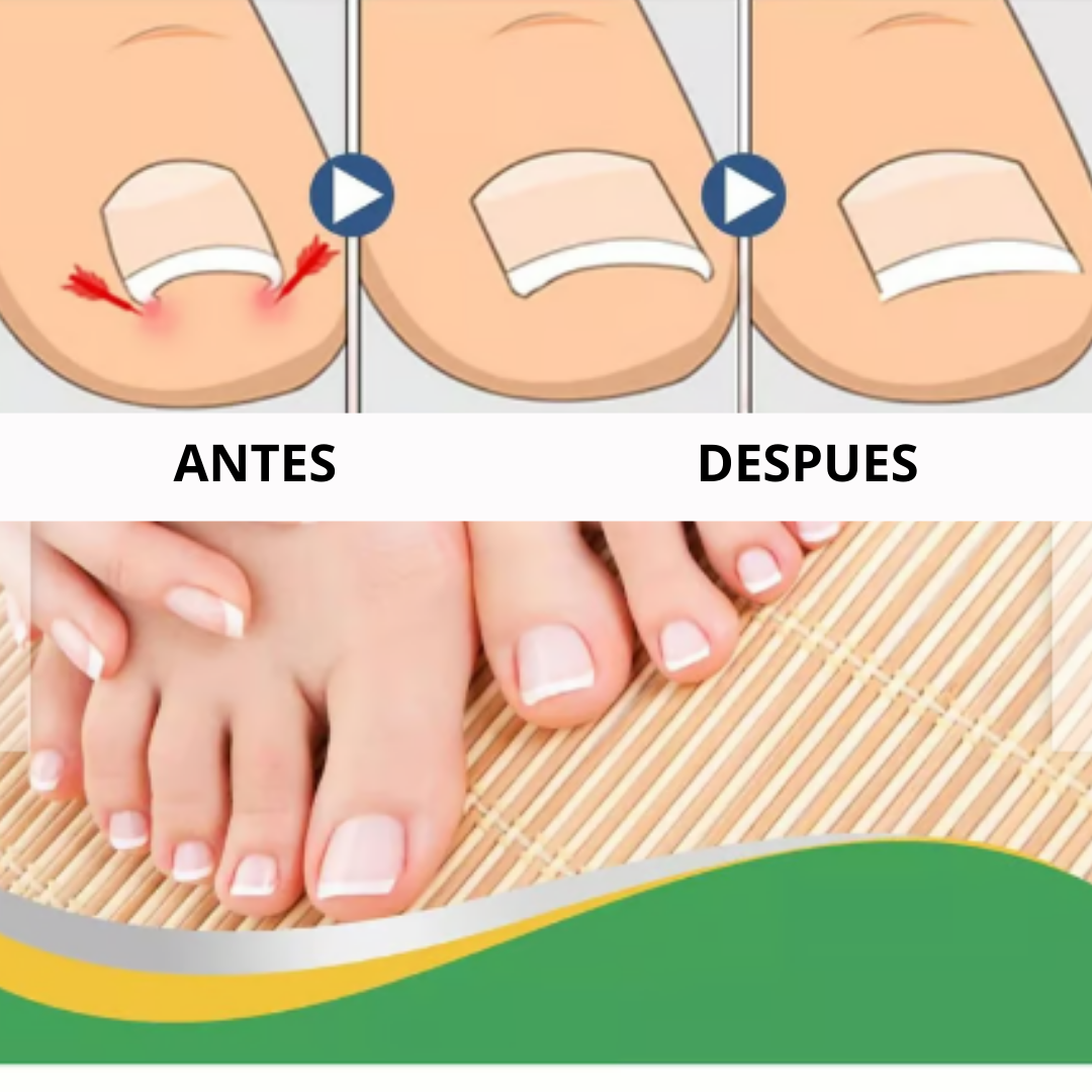 50 Parches Correctores Uñas
